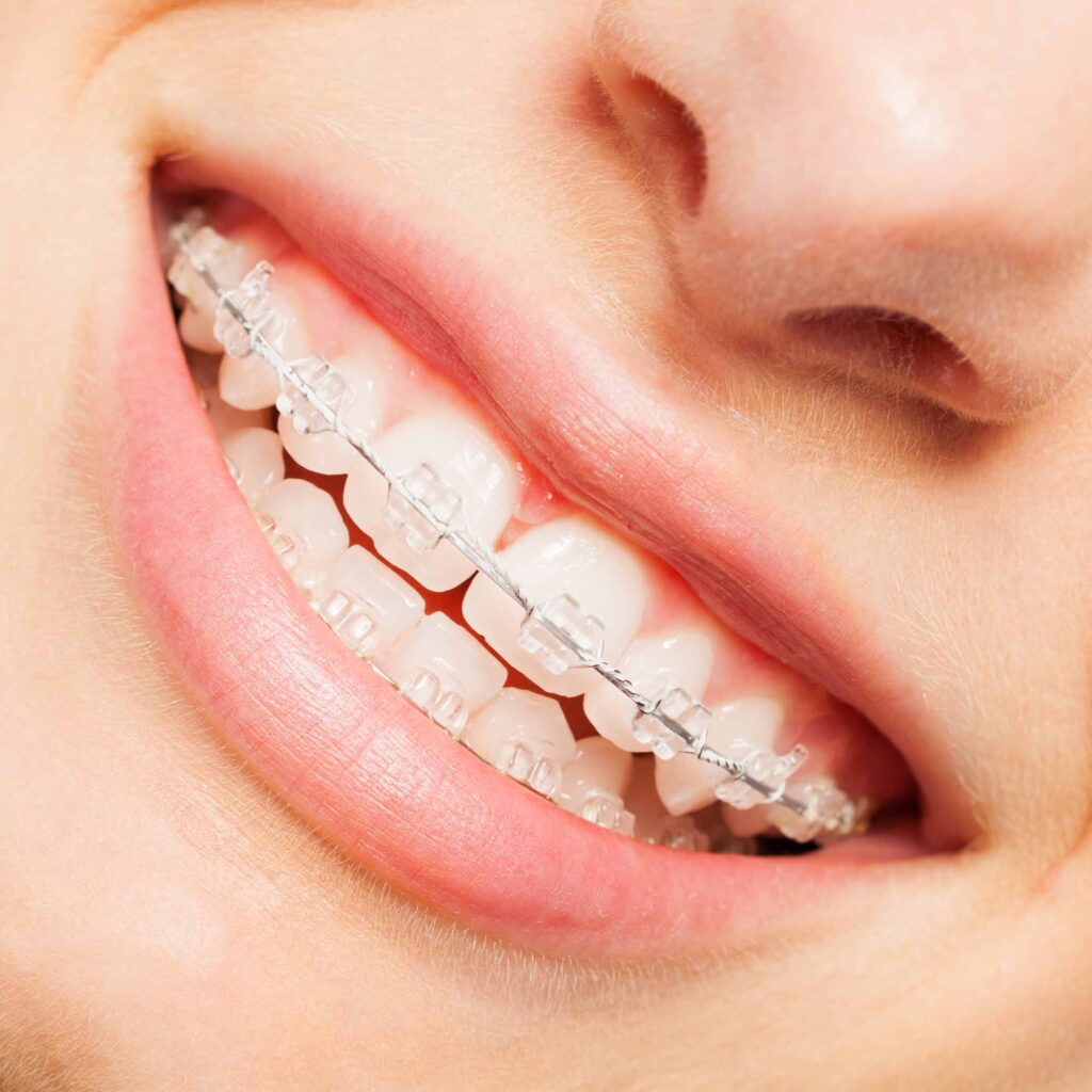 burckhard-ortho-hero-clear-braces-smile